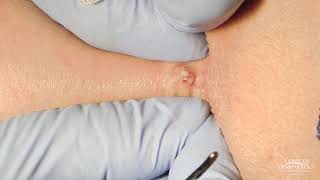 This quotTiny Pimplequot Gets Squeezed  Cyst Squeeze  CONTOUR DERMATOLOGY [upl. by Aelhsa]