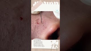 Big Cystic Acne Blackheads Extraction Blackheads amp Milia Whiteheads Removal Pimple Popping shorts [upl. by Acined]