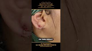 Ear Lobule Repair Restoring Beautiful Earlobes [upl. by Yzmar]