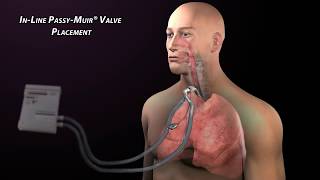 Passy Muir Valve with Mechanical Ventilation [upl. by Lovash695]