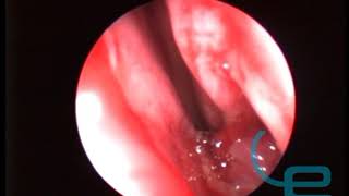 Biopsia de masa sobre mucosa olfatoria en perro mediante rinoscopia [upl. by Joktan162]