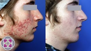 Laser Cystic Acne amp Acne Scar Removal Treatment [upl. by Giuliana]