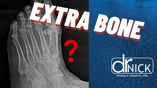 Extra bone in your foot The accessory navicular bone  Dr Nick [upl. by Fante]