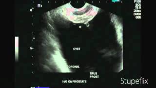 Ultrasound video of cystitis cystica [upl. by Gabrielle437]