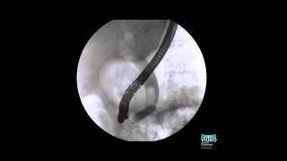 Endoscopic partial sphincterotomy coupled with large balloon papilla dilation [upl. by Slein]