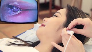 【ASMR】Experience the most professional visual ear cleaning Dig earwax relax ear massage [upl. by Cherin]