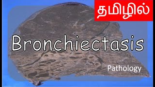 Bronchiectasis  Pathology  தமிழில்  Explained clearly [upl. by Mila]