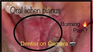 Oral lichen planus  What is OLP  Dentist on Camera  Dr Mangal Gupta [upl. by Renee650]