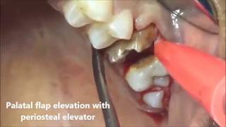 Root stump of molar extraction using periosteal elevator [upl. by Aihsad]