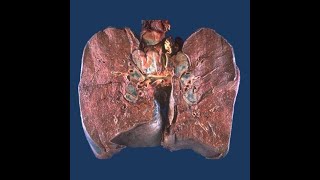 GENERAL PATHOLOGY 28  sarcoidosis DR SAMEH GHAZY [upl. by Auhsuoj]