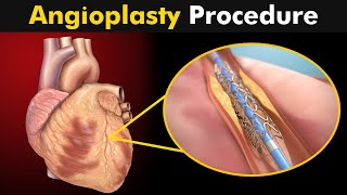 How Angioplasty Procedure is performed [upl. by Gudrin831]