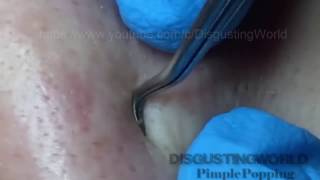 Blackhead Squeezed Pimple Removal  1 Part [upl. by Dorita74]