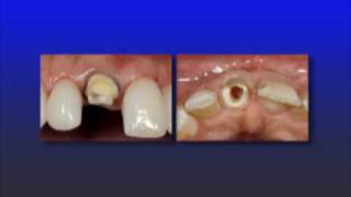 Endodontically Treated TeethEsthetic Management [upl. by Ponzo]