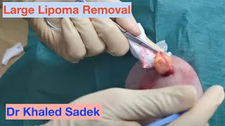 Lipoma Removal  Dr Khaled Sadek LipomaCystcom [upl. by Abernon171]