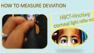 Hirschberg Test Hirschberg Corneal Reflex Test Hirschberg Test Interpretation HBCT Test HBRTCLR [upl. by Kentigerma]