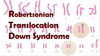 Robertsonian Translocation Down Syndrome ROB [upl. by Naasar]