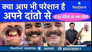 पायरिया के कारण गिरे दांतों का इलाज 7 दिन में I Full mouth implants Youdent I Best implant clinic [upl. by Anya]