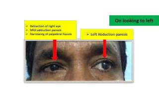 Duanes Retraction Syndrome [upl. by Ettenom]