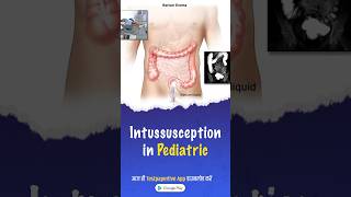 Intussusception Pediatric Causes Symptoms Diagnosis Intussusception pediatrics testpaperlive [upl. by Senior]