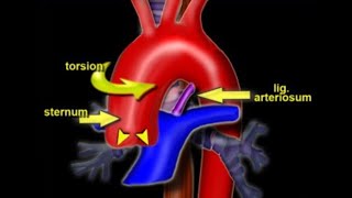 Ligamentum arteriosum and its clinical significance [upl. by Tierney]