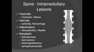 Localization of Spinal Masses  Introduction [upl. by Leiand]