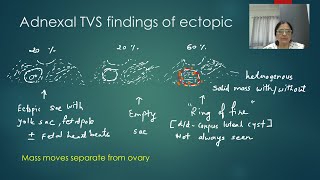 Diagnosis of unruptured tubal ectopic pregnancy by Dr Anjali kawthalkar [upl. by Parrisch271]