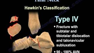 Talus fracture Hawkins Classificaiton  Everything You Need To Know  Dr Nabil Ebraheim [upl. by Maynord]