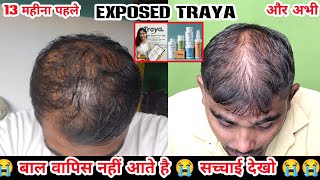 Exposed traya hair review 13 महीना हो गए और बाल वापिस नहीं आए मेरे 😭  traya hair review hindi [upl. by Cortie]