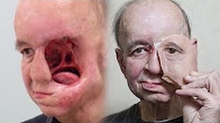 3D printed face gives man with half a face a new life Face transplant before amp after  compilation [upl. by Ilatfan]