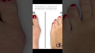 Revolutionary Bunion Surgery A GameChanger for Foot Pain Relief [upl. by Freeborn]