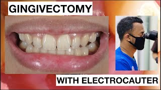 Gingivectomy in simple case Lateral with ElectroCautery  General Dentist Griya RR [upl. by Jollanta]