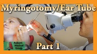 Myringotomy amp Ear Tube Part 1 Feat Dr Tim Fife  Myringotomy  Auburn Medical Group [upl. by Eicrad]