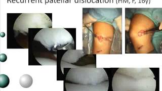 Patellofemoral Instability Treatment with Medial Patellofemoral Ligament [upl. by Mcnalley]