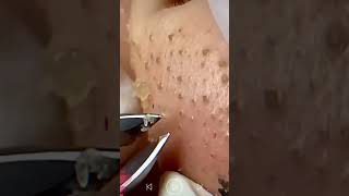 Skincare  Blackheads Removal 239 tweezers skincare blackheads blackheads [upl. by Marko873]