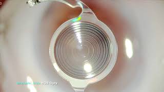 TECNIS Synergy™ IOL a ContinuousRangeofVision Intraocular Lens IOL at OPTY Eye Hospital Chain [upl. by Aihsatan]