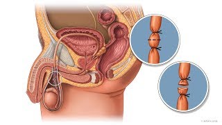 Mayo Clinic Minute Why a vasectomy is a great option for birth control [upl. by Abrahamsen]