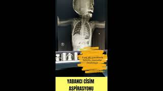 YABANCI CİSİM ASPİRASYONUNDA DİKKAT EDİLMESİ GEREKEN NOKTALAR DİREK GRAFİ TOMOGRAFİ GÖRÜNTÜLERİ [upl. by Deehahs634]