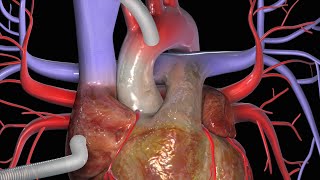 Graft di Bypass Aortocoronarico CABG [upl. by Garlen]