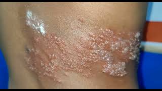 What is Shingles and its Treatment [upl. by Albina]