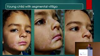 Targeted Phototherapy in Vitiligo [upl. by Nettle707]