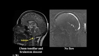 Cine MRI for Chiari I Malformation [upl. by Iras]