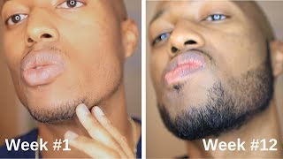 Minoxidil Beard Journey 3 Month Transformation [upl. by Terrance20]