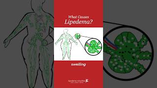 What really causes lipedema lymphedema and lipolymphedema [upl. by Yram]