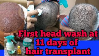 HAIR TRANSPLANT FIRST WASH  AFTER 11 DAYSBEST HAIR TRANSPLANT INDIA  Hair Transplant Cost [upl. by Sayles789]