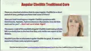 Angular Cheilitis Cream  Angular Cheilitis Treatment [upl. by Yrrehs830]