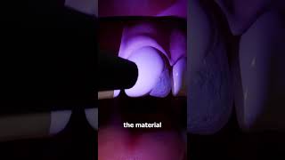 Fixing a chipped tooth😁 subscribe [upl. by Nois]