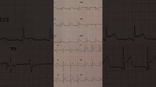 Acute Pericarditis ECG Example 3 [upl. by Nader]