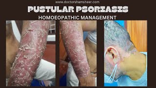 PUSTULAR PSORIASIS [upl. by Bubalo]