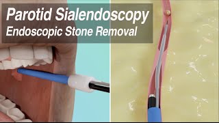 Parotid Sialendoscopy Endoscopic Duct Stenosis Balloon Dilation amp Salivary Stone Removal [upl. by Everest]