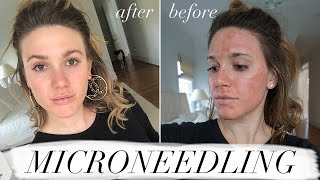 MY FIRST MICRONEEDLING EXPERIENCE amp WHAT TO EXPECT ACNE SCAR TREATMENT [upl. by Ahsenroc]